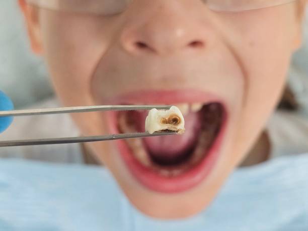 Best Emergency Root Canal Treatment in Privateer, SC